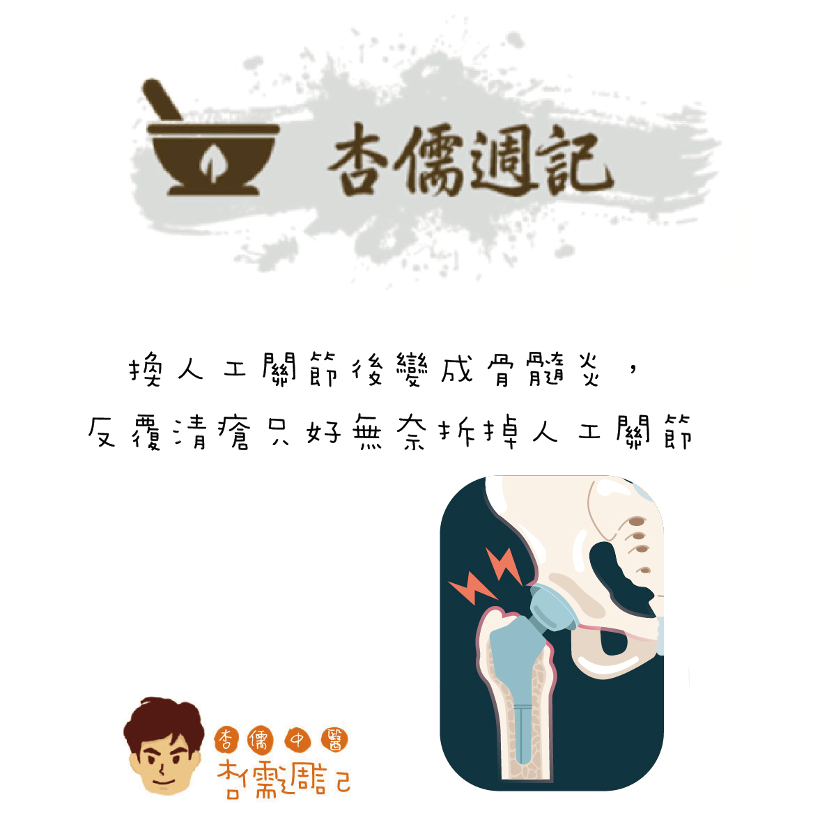 換人工關節後變成骨髓炎，反覆清瘡只好無奈
